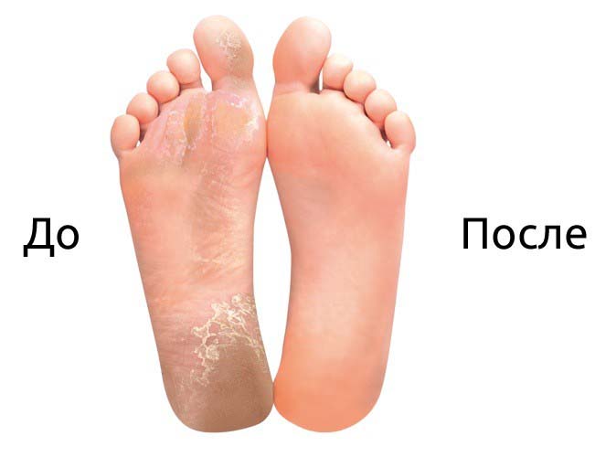 Педикюрные носочки удаляют все эти дефекты и кожа ступней постепенно становится гладкой, мягкой и приятной на вид.